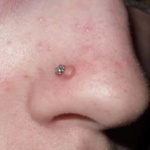 Anzeichen einer Knorpelirritation - Nase